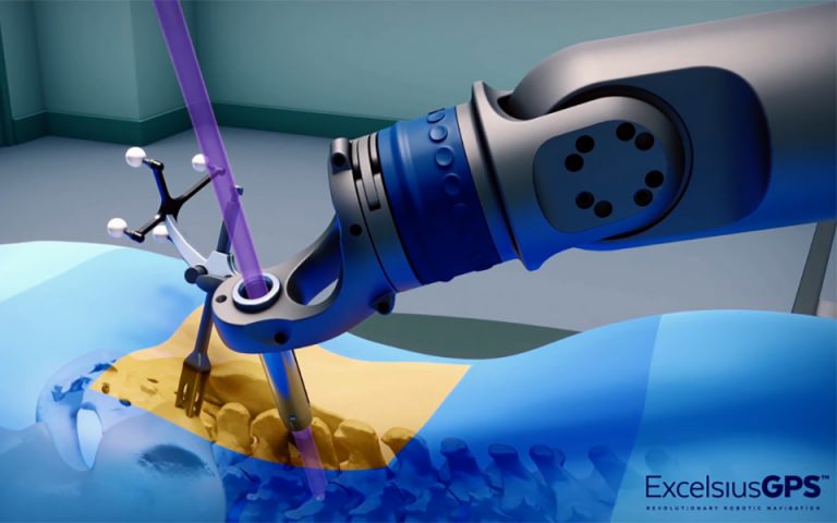Ρομποτική χειρουργική σπονδυλικής στήλης με GPS: μόνο στο Metropolitan