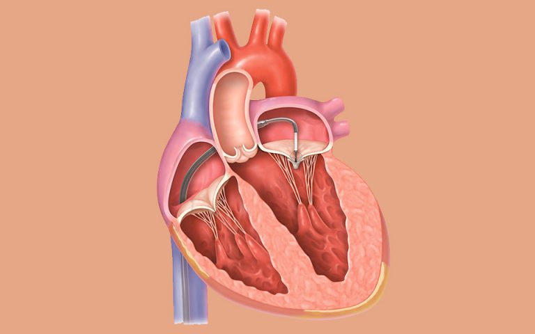 MitraClip στο Metropolitan: Επιδιόρθωση βαλβίδας της καρδιάς χωρίς διάνοιξη του θώρακα