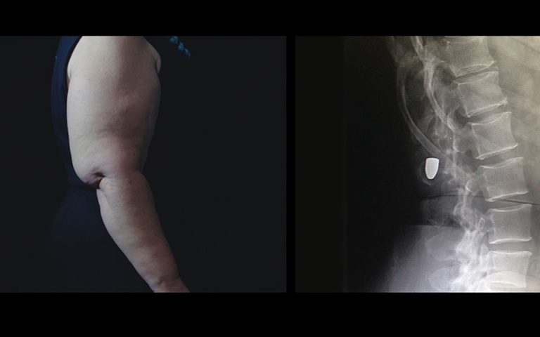 Βίντεο New York Times: Πώς είναι να ζεις με μια σφαίρα στο σώμα σου;