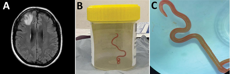 Παγκόσμια πρώτη: Βρήκαν ζωντανό παρασιτικό σκουλήκι από… πύθωνα στον εγκέφαλο γυναίκας-1