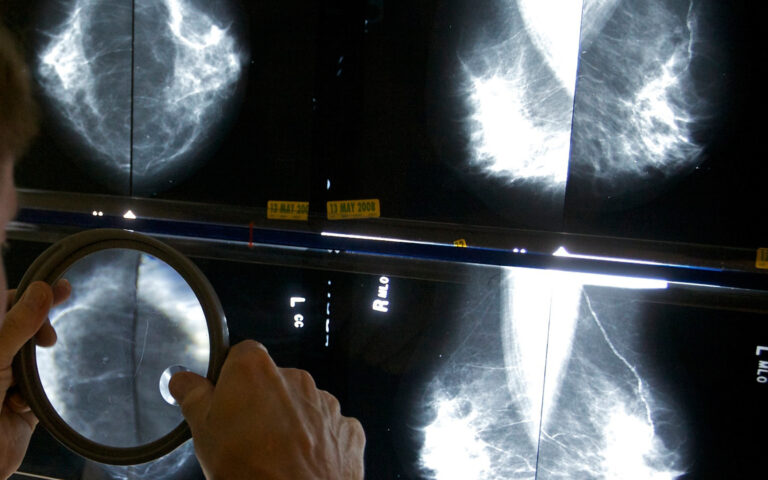 Η Τεχνητή Νοημοσύνη στη μάχη της διάγνωσης του καρκίνου του μαστού