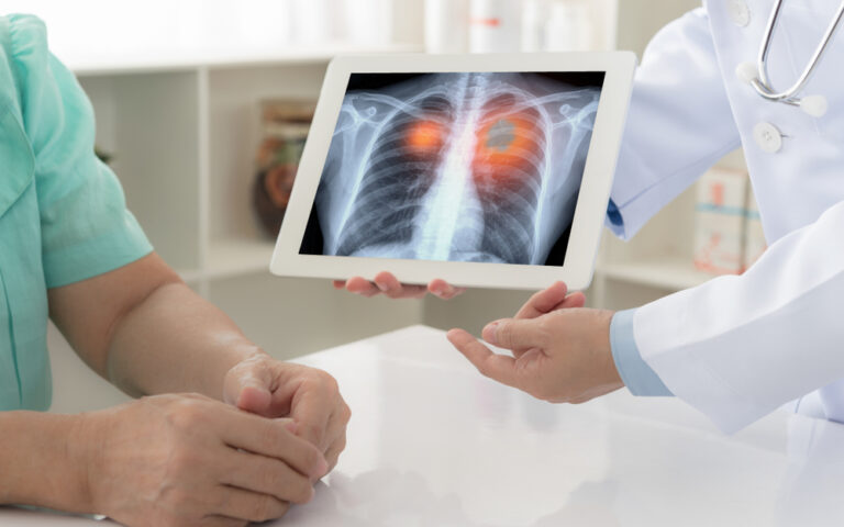 Καρκίνος του πνεύμονα: Μελέτη αναδεικνύει τον ρόλο «κλειδί» του προσυμπτωματικού ελέγχου